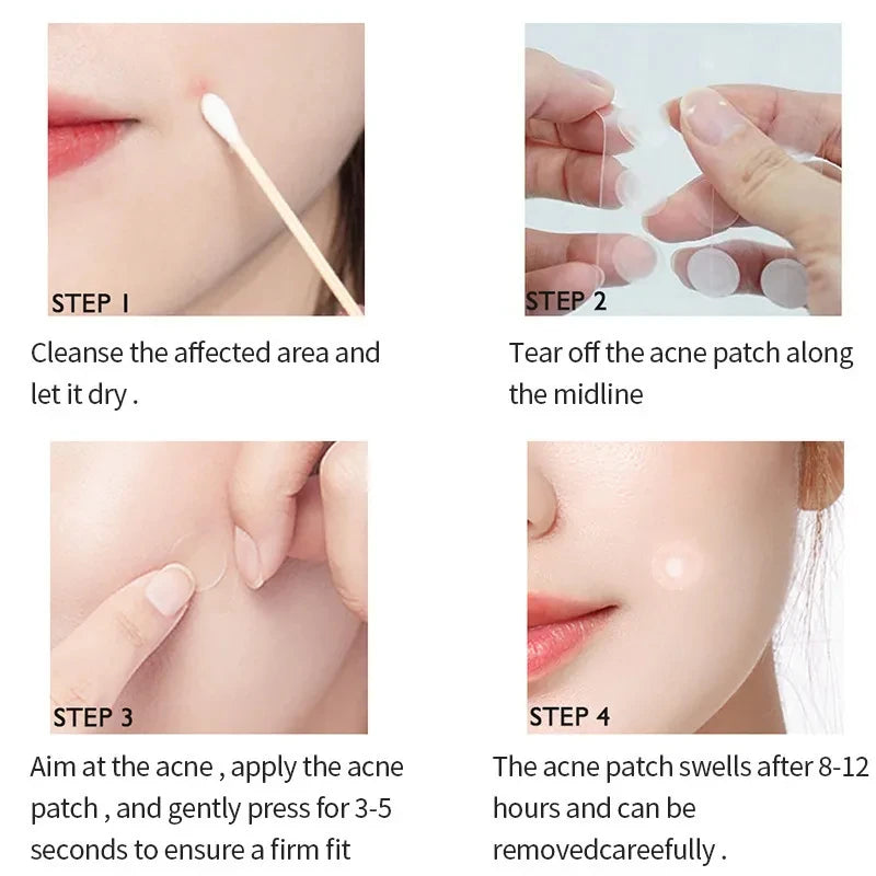 hydrocolloid patches